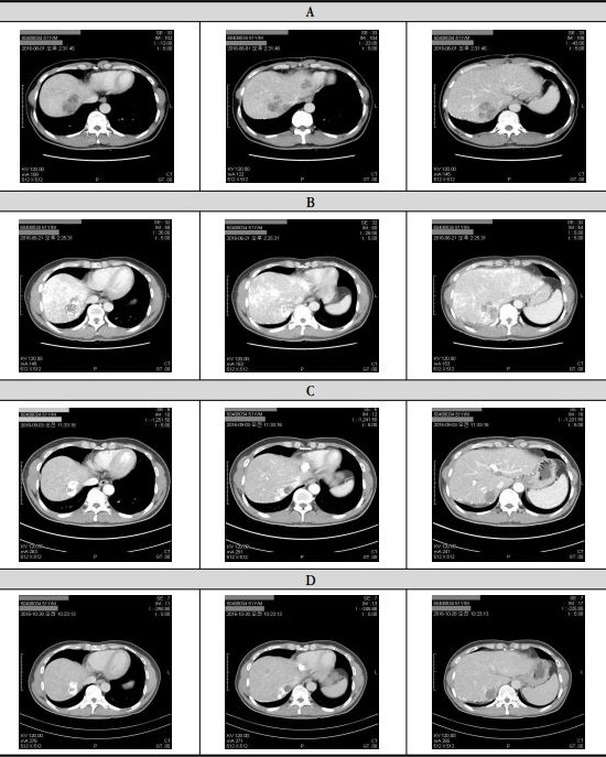 종양 크기 변화를 나타낸 CT 촬영사진